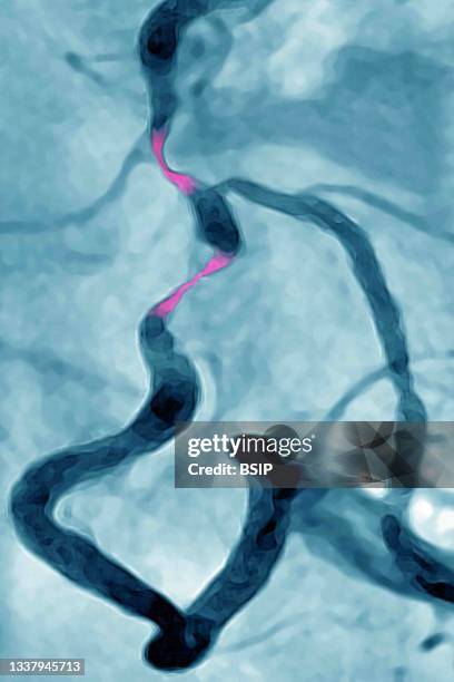 Myocardial infarction with two stenosis in the right coronary artery. Coronary angiography.