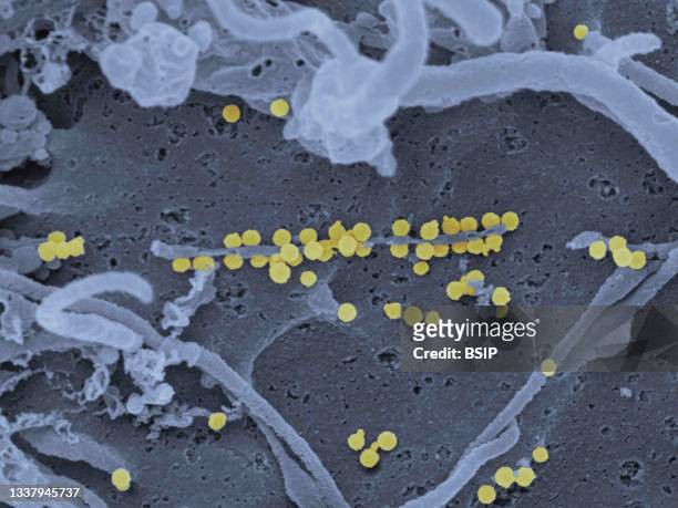 Scanning electron micrograph of Crimean-Congo hemorrhagic fever viral particles budding from the surface of cultured epithelial cells from a patient.
