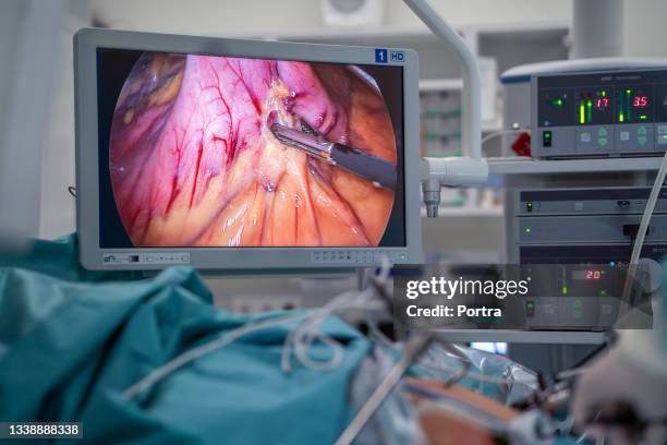 doctors performing bariatric surgery - bariatric stock pictures, royalty-free photos & images