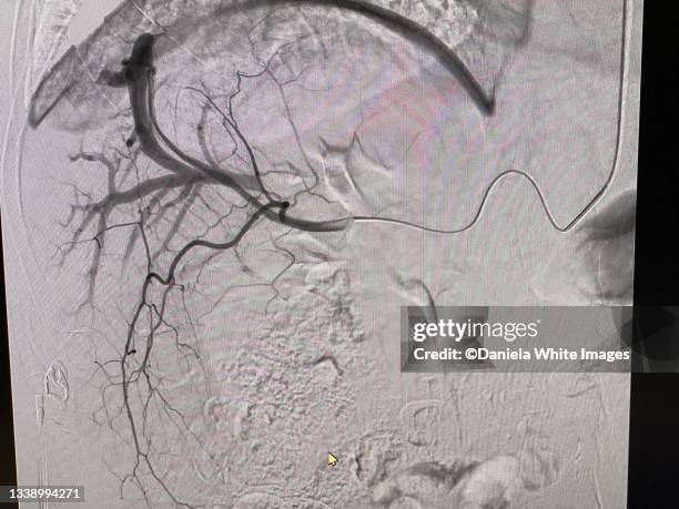 x-ray of liver - cirrhosis bildbanksfoton och bilder