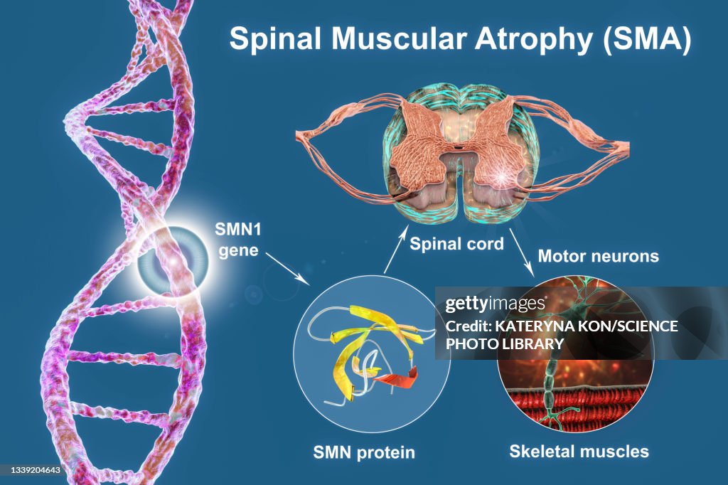 Spinal Muscular Atrophy Illustration High Res Vector Graphic Getty Images spinal-muscular-atrophy-illustration-high-res-vector-graphic-getty-images