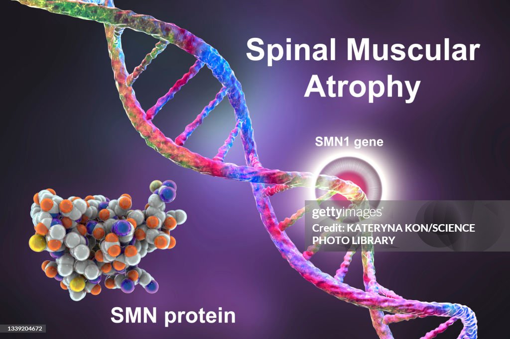 Spinal Muscular Atrophy Illustration High Res Vector Graphic Getty Images spinal-muscular-atrophy-illustration-high-res-vector-graphic-getty-images