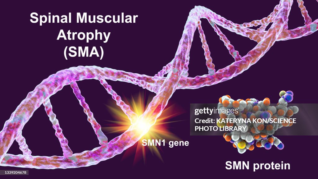 Atrophy Gif Spinal Muscular Atrophy Illustration High-Res Vector Graphic - Getty Images