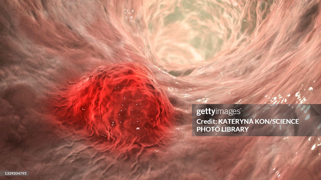 Intestinal carcinoma, illustration