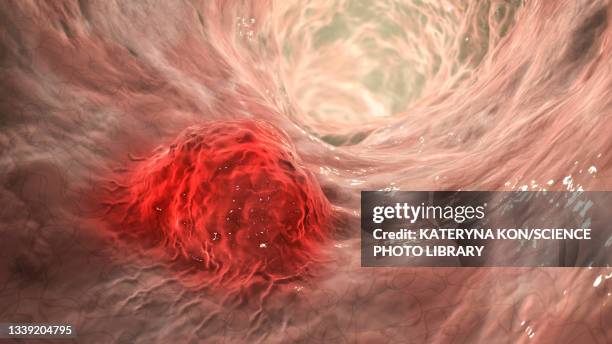 intestinal carcinoma, illustration - cancer tumour stock illustrations