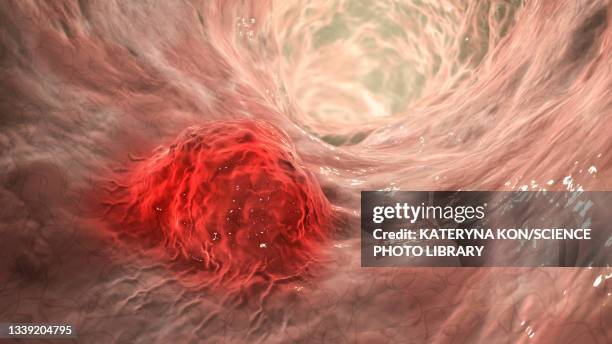 intestinal carcinoma, illustration - intestine 3d stock illustrations