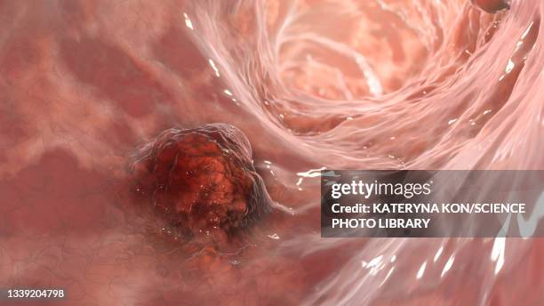 intestinal carcinoma, illustration - biopsy stock illustrations