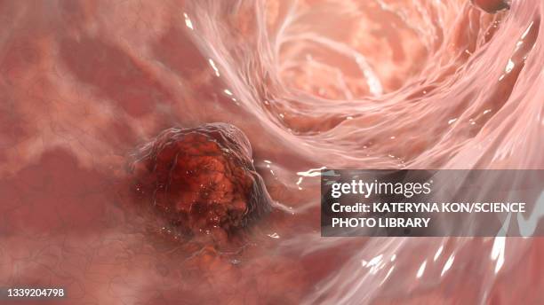 intestinal carcinoma, illustration - carcinoma stock illustrations