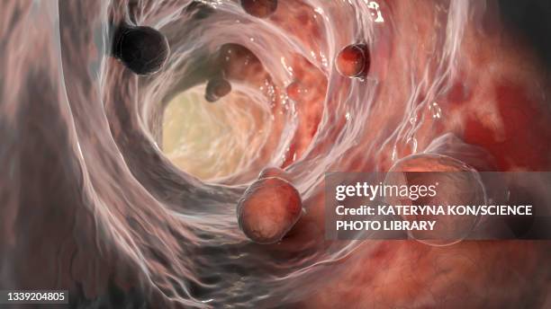 illustrazioni stock, clip art, cartoni animati e icone di tendenza di colorectal polyps, illustration - cancro tumore