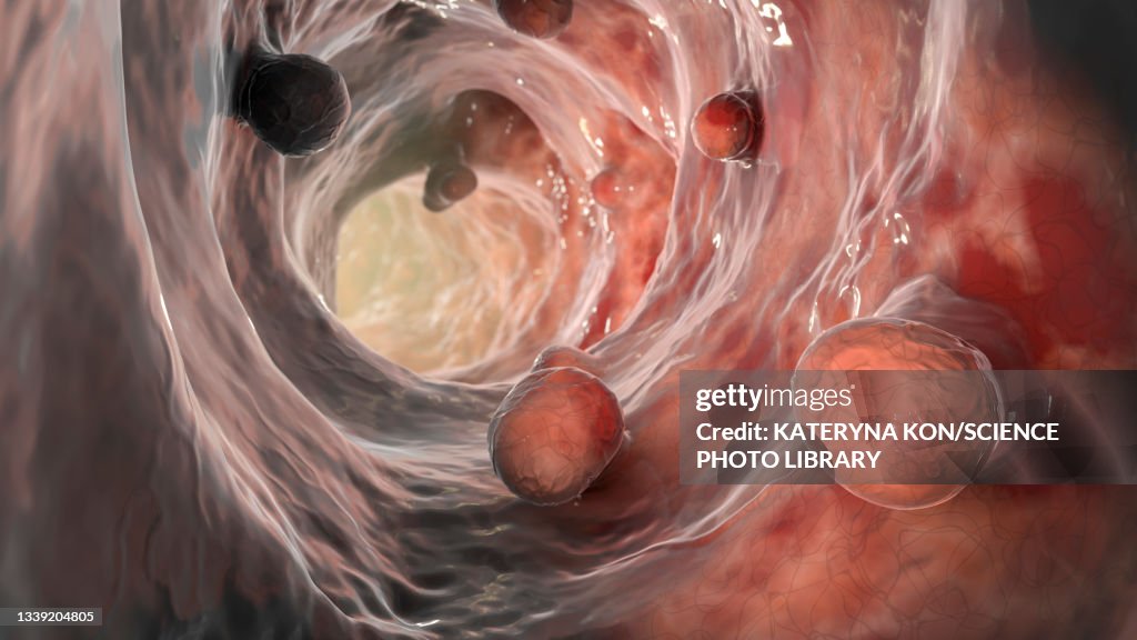 Colorectal polyps, illustration
