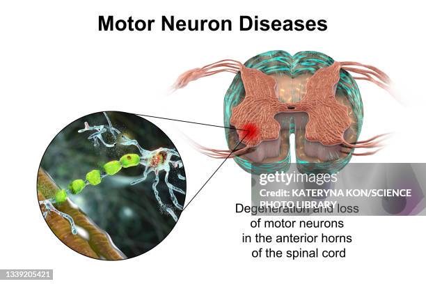 motor neuron diseases, illustration - motor neuron stock-grafiken, -clipart, -cartoons und -symbole