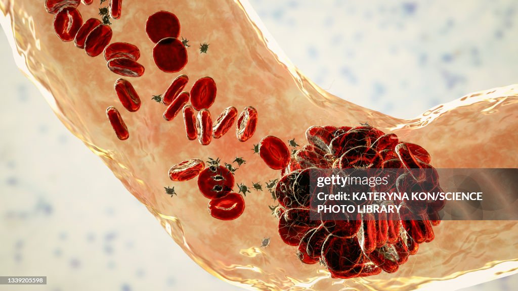 Blood clot, illustration