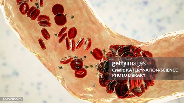 bildbanksillustrationer, clip art samt tecknat material och ikoner med blood clot, illustration - blodpropp