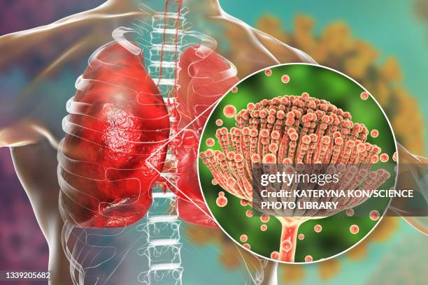 illustrazioni stock, clip art, cartoni animati e icone di tendenza di pulmonary aspergillosis, illustration - attrezzatura per la respirazione artificiale