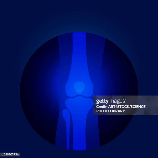 ilustraciones, imágenes clip art, dibujos animados e iconos de stock de knee x-ray, illustration - reemplazo