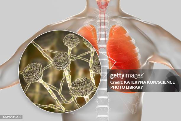 pulmonary aspergillosis, illustration - spore stock illustrations