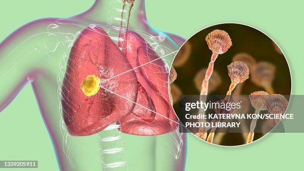 pulmonary aspergillosis, illustration - aspergillus fumigatus stock illustrations