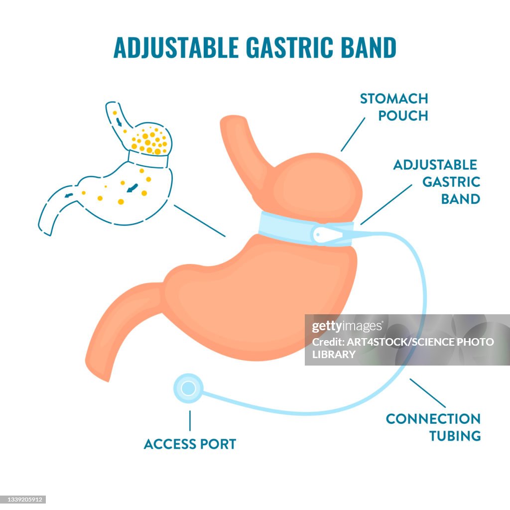 Adjustable gastric band bariatric surgery, illustration