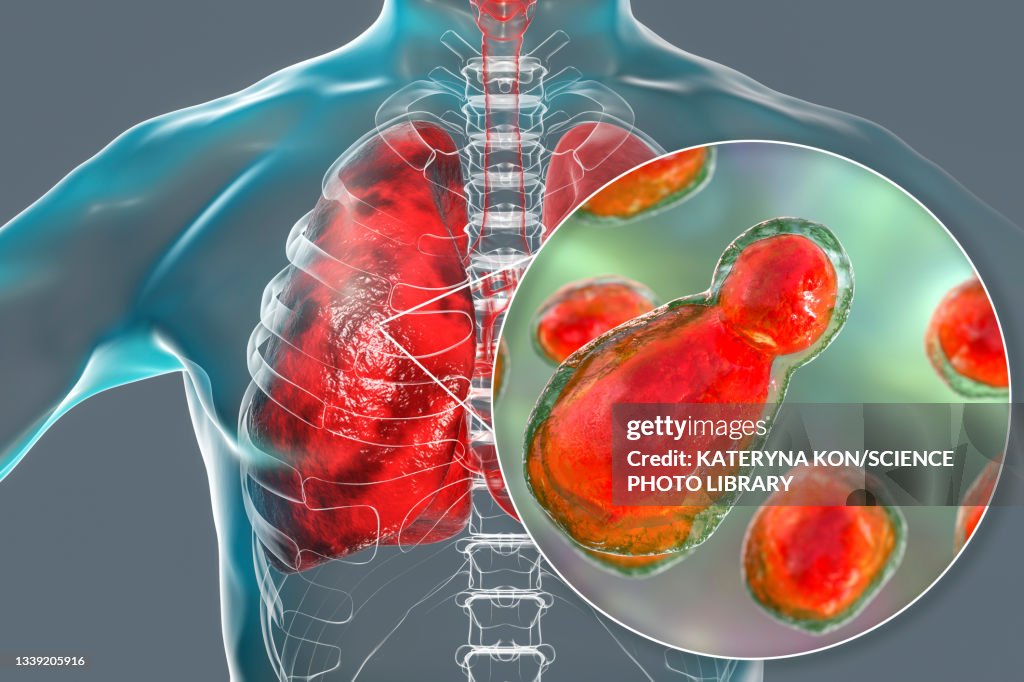 Pulmonary cryptococcosis, illustration