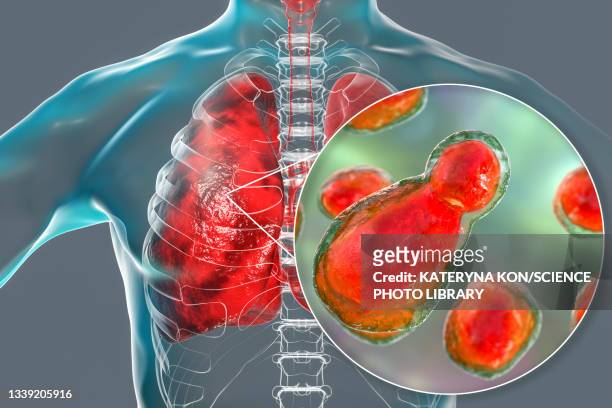 ilustraciones, imágenes clip art, dibujos animados e iconos de stock de pulmonary cryptococcosis, illustration - sistema inmunocomprometido