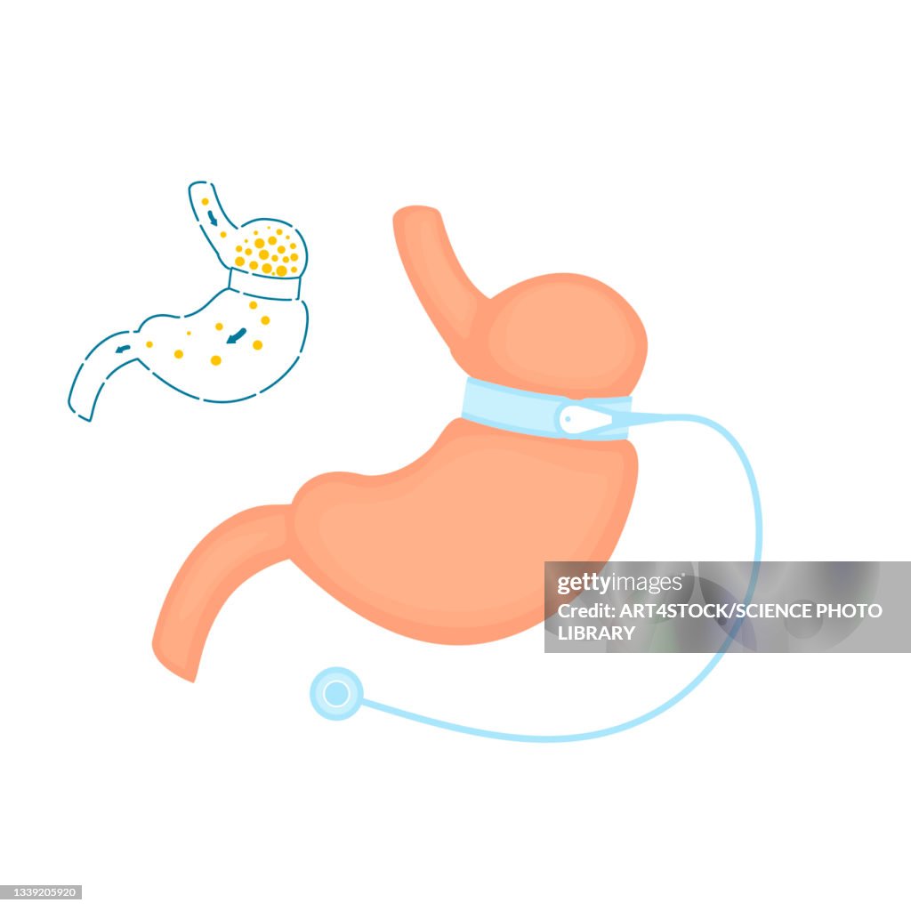 Adjustable gastric band bariatric surgery, illustration