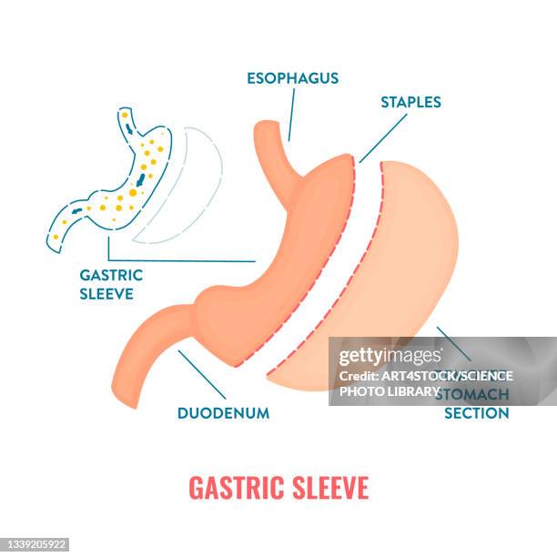 gastric sleeve bariatric surgery, illustration - 内視鏡点のイラスト素材／クリップアート素材／マンガ素材／アイコン素材