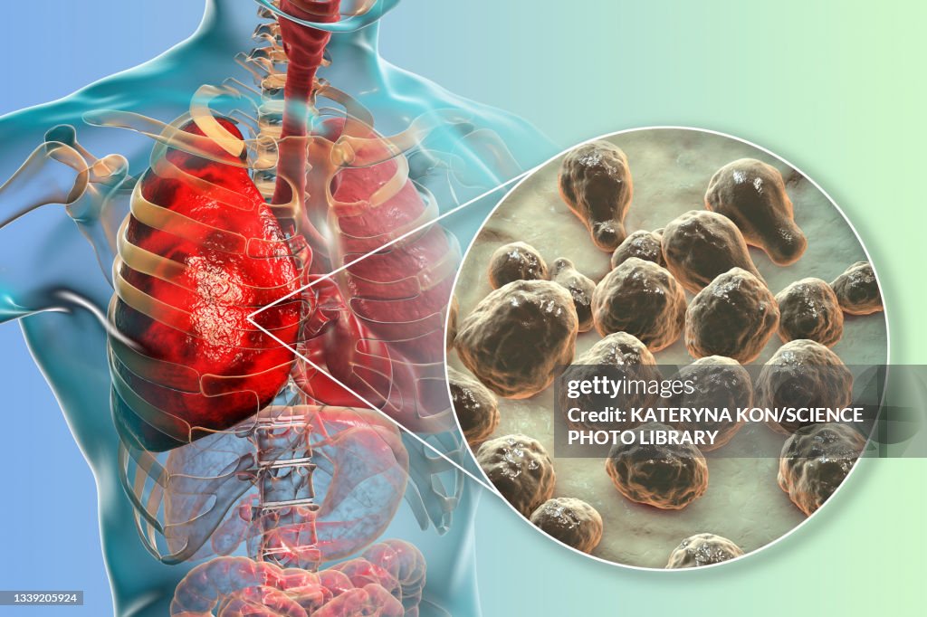 Pulmonary cryptococcosis, illustration