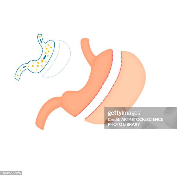gastric sleeve bariatric surgery, illustration - laparoscopic surgery instrument stock illustrations