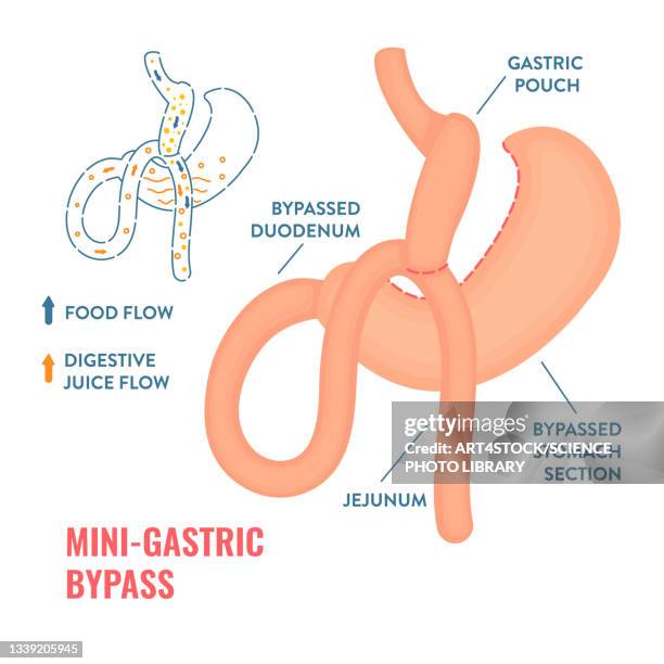 mini gastric bypass bariatric surgery, illustration - 内視鏡点のイラスト素材／クリップアート素材／マンガ素材／アイコン素材