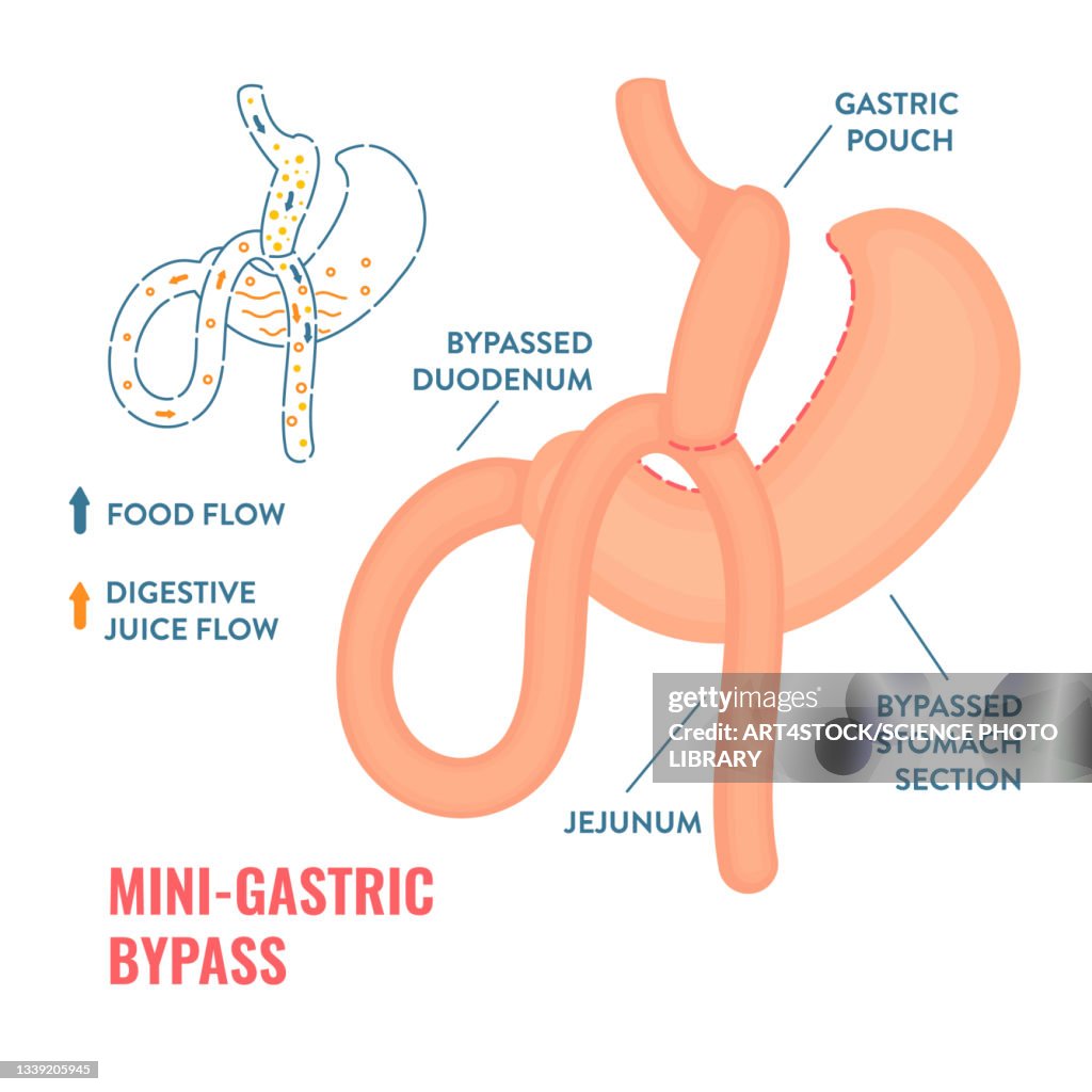 Mini gastric bypass bariatric surgery, illustration