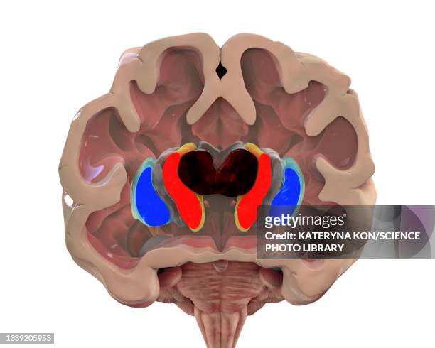 dorsal striatum in huntington's disease, illustration - cerebral hemisphere 幅插畫檔、美工圖案、卡通及圖標