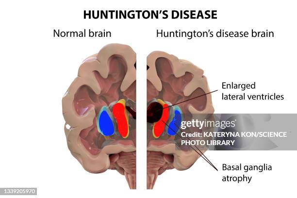 normal brain and brain in huntington's disease, illustration - corpus striatum stock illustrations