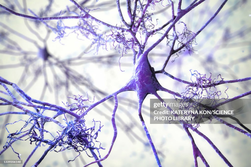 Nerve cells affected by Alzheimer's disease, illustration