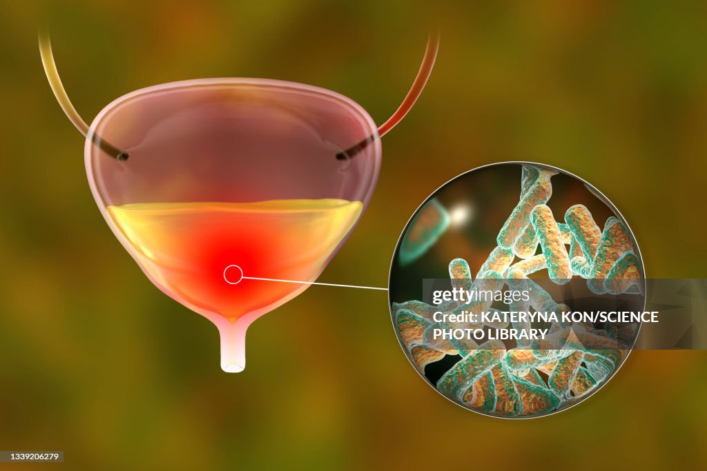 Define Cystitis Bacterial Cystitis Illustration High-Res Vector Graphic - Getty Images