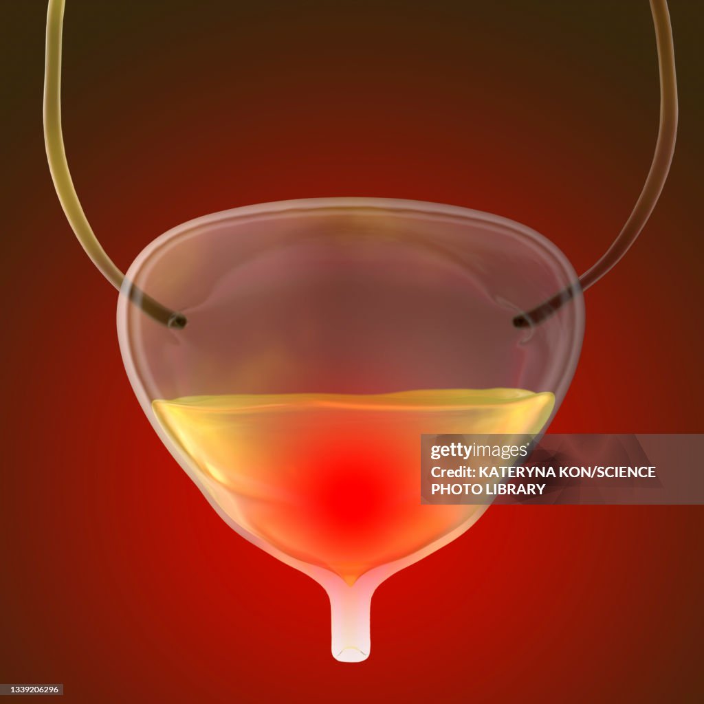 Define Cystitis Cystitis Illustration High-Res Vector Graphic - Getty Images