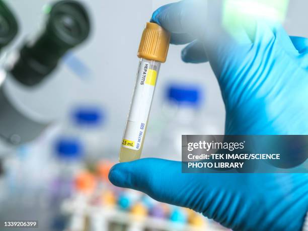 medical testing - hepatite imagens e fotografias de stock