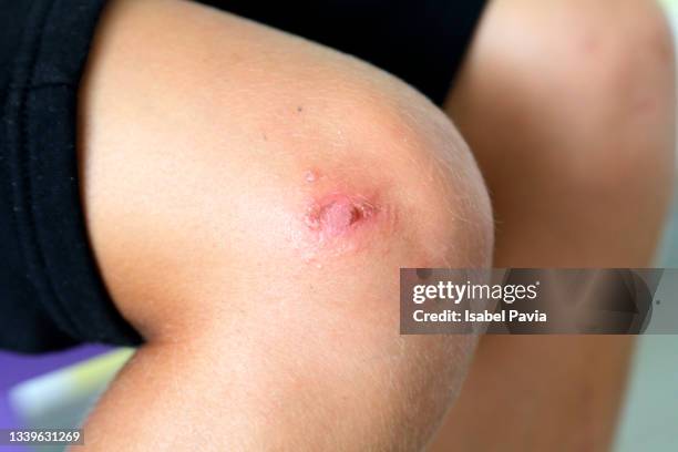grazed knee, close-up - wunde stock-fotos und bilder