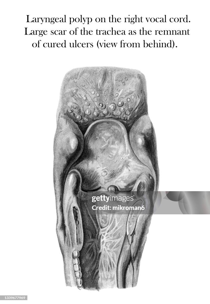 Old engraved illustration of Throat diseases, Laryngeal polyp on the right vocal cord. Large scar of the trachea as the remnant of cured ulcers (view from behind)
