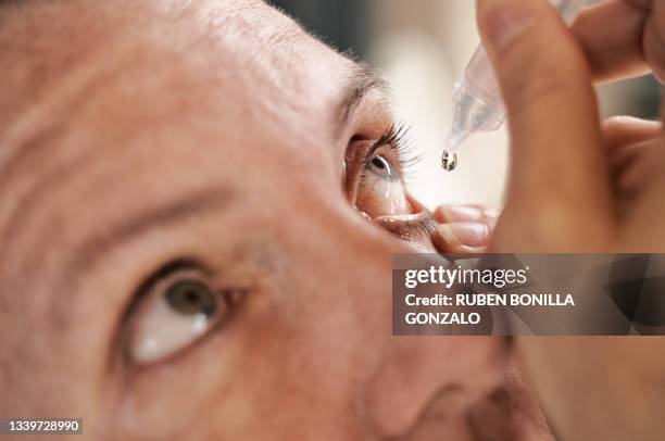 ophthalmologist pouring eye drops in the eye of a caucasian patient with conjunctivitis. - allergy doctor stockfoto's en -beelden