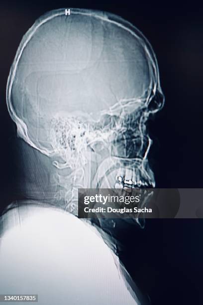 x-ray of human skull - skull xray no brain stock pictures, royalty-free photos & images