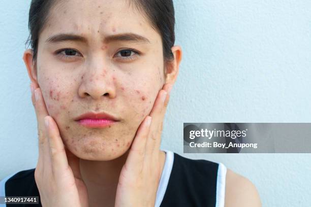 portrait of asian woman having acne inflamed on her face and she looking at the camera. - ugly face stockfoto's en -beelden