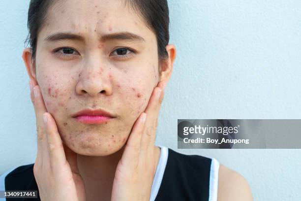 portrait of asian woman having acne inflamed on her face and she looking at the camera. - ugly face 個照片及圖片檔