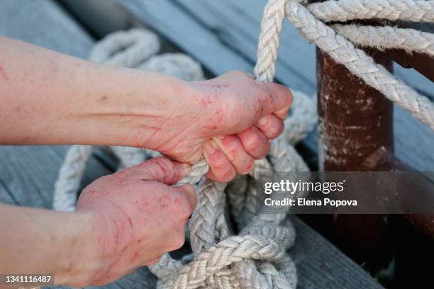 cropped woman's hands with scratching skin after sailing lesson - dermatitis stock pictures, royalty-free photos & images