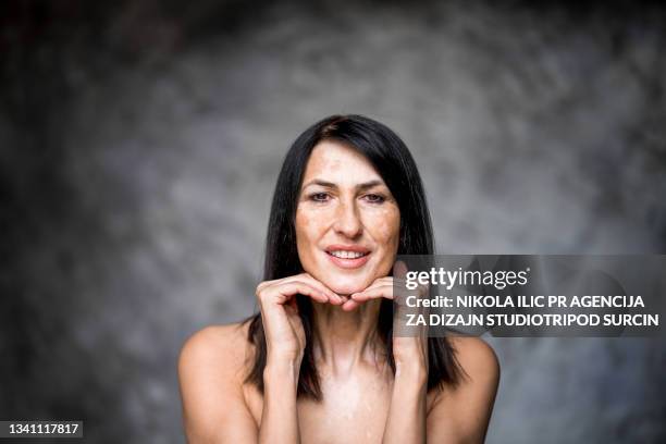 beautiful caucasian senior woman with skin problems vitiligo - vitiligo face stockfoto's en -beelden