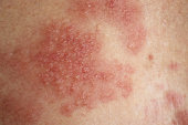 Eczema disease on the skin close up