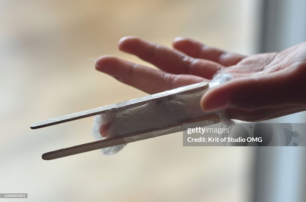 The homemade soft splint broken finger