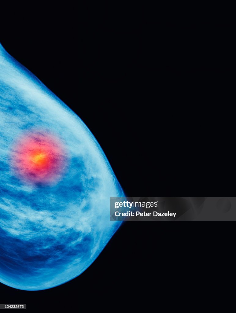 Mammogram showing cancer growth