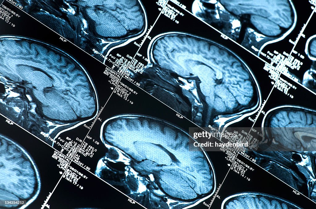 MRI Scan mit Gehirn mehrere Bilder von Kopf und Totenkopf