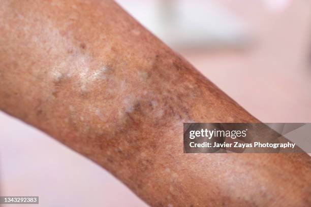 varicose veins - varicose vein stock pictures, royalty-free photos & images