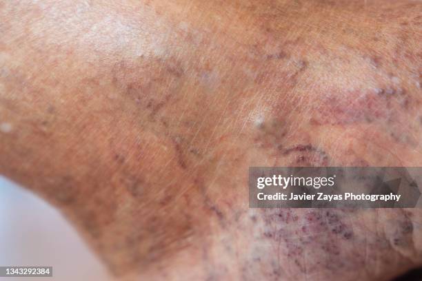 varicose veins - blood clot photos et images de collection